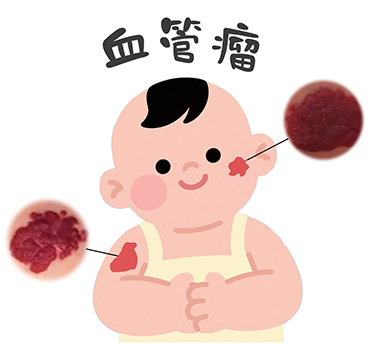 <strong>血管瘤长在哪个位置风险较高？需要注意什么？</strong>