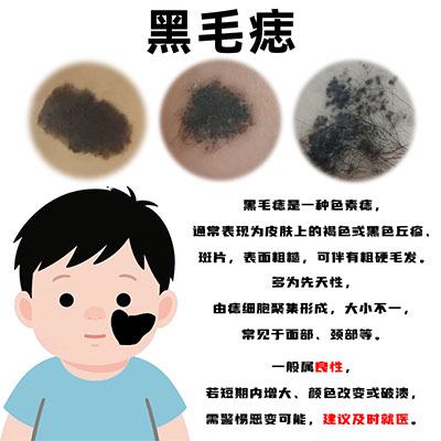 南京治疗医院排名靠前：胎记黑色素痣如何去除？